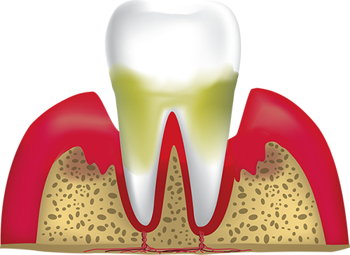 advanced periodontitis Hyannis, MA