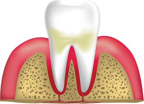 gingivitis Hyannis, MA