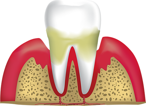 periodontitis Hyannis, MA