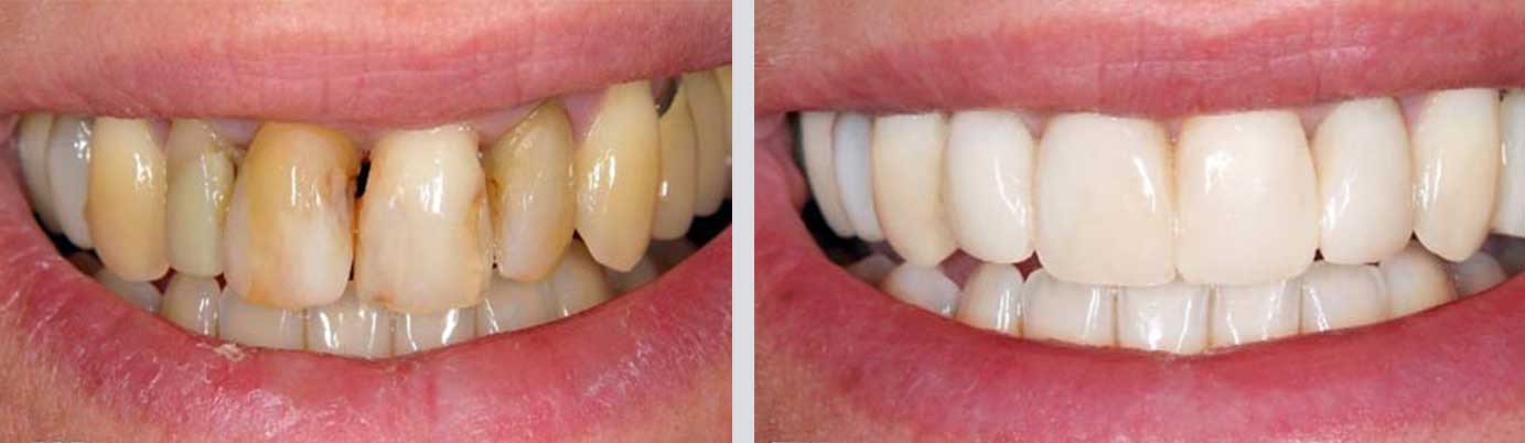 cosmetic dentistry before and after