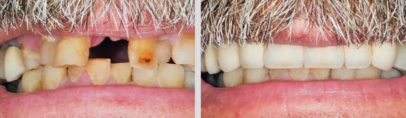 cosmetic dentistry before and after