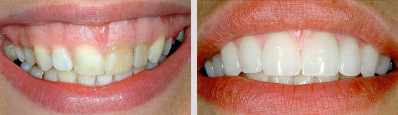 cosmetic dentistry before and after