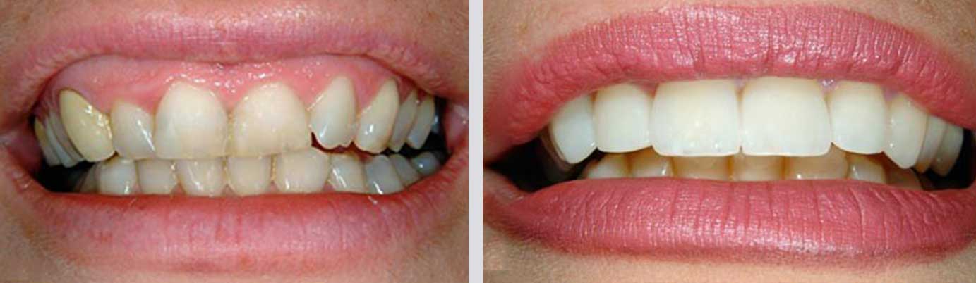 cosmetic dentistry before and after