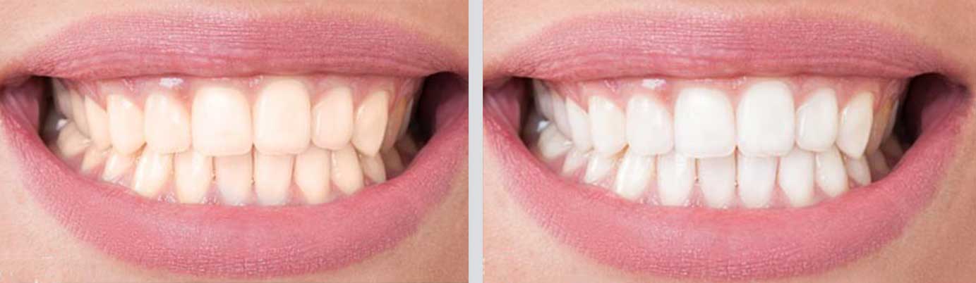 cosmetic dentistry before and after