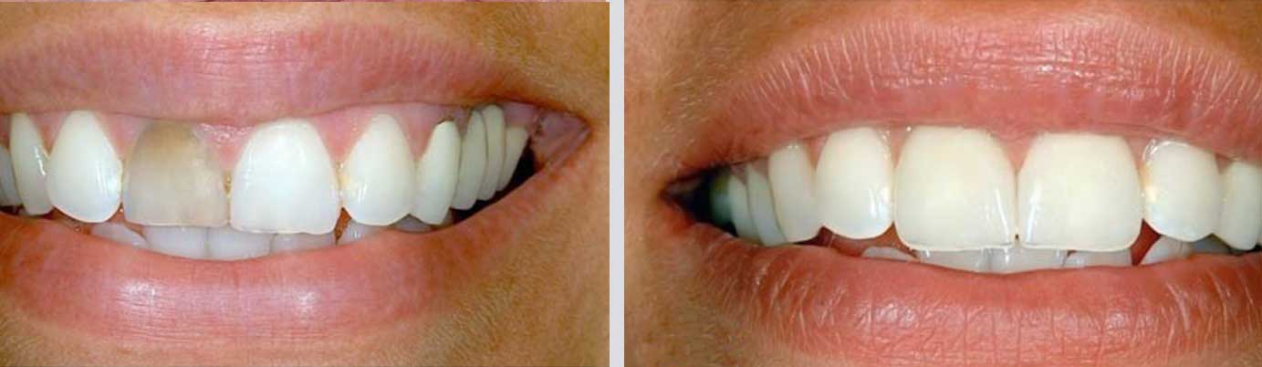 cosmetic dentistry before and after